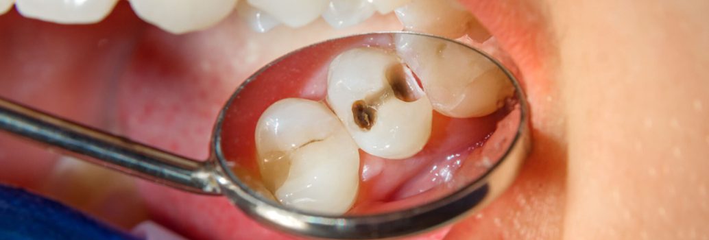 حفره دندان / پوسیدگی دندان: علل، علائم، پیشگیری