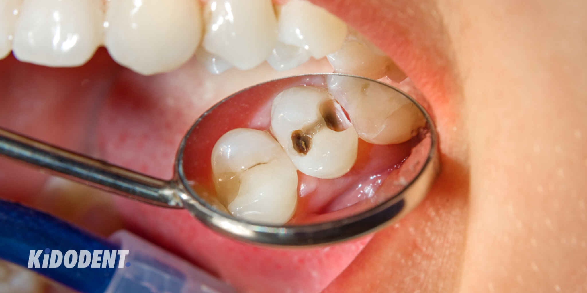 حفره دندان / پوسیدگی دندان: علل، علائم، پیشگیری