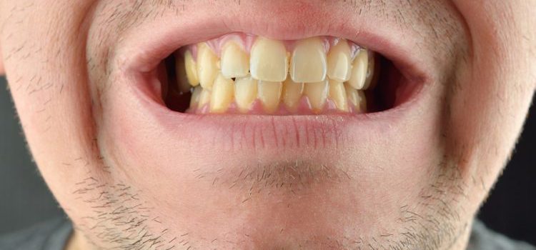 چرا دندان ها زرد می شوند؟  – پلی کلینیک سلامت دهان و دندان DentAtlas