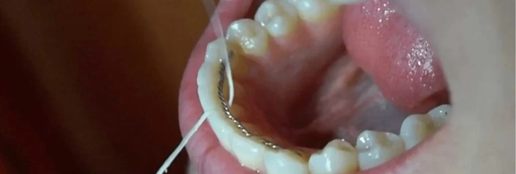 چگونه با نگهدارنده دائمی نخ دندان بکشید؟