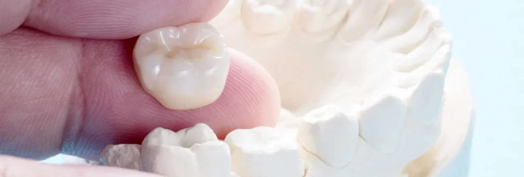انواع روکش دندان و هزینه: نحوه انتخاب بهترین