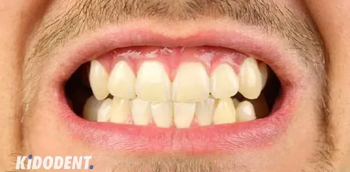 چگونه دندان قروچه را در شب یا روز متوقف کنم؟